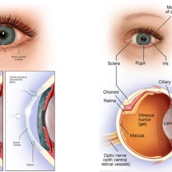 Cornea Transplant
