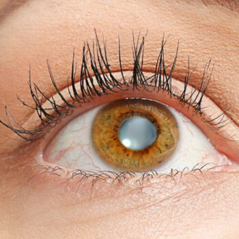 Cataract Surgery
